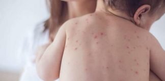 Emiten alerta epidemiológica por casos de sarampión importados