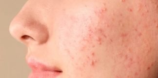 Dermatología puede mejorar calidad de vida en personas con afecciones de la piel acne
