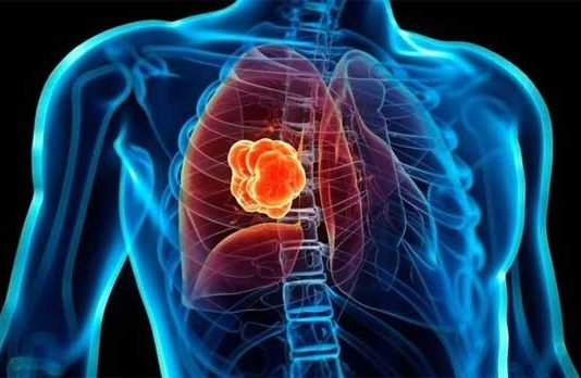Cáncer pulmón