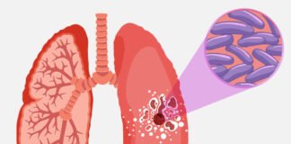 La tuberculosis es curable si se detecta a tiempo: IMSS