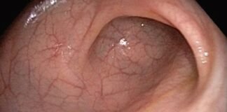 Un 70 por ciento de casos de Cáncer de colon es curable: ISSSTE