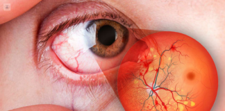 Llama IMSS Hidalgo a prevenir la ceguera por retinopatía diabética