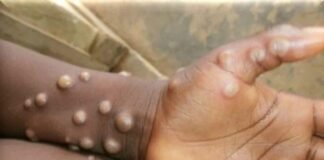 Confirma Estados Unidos primer caso de viruela del mono