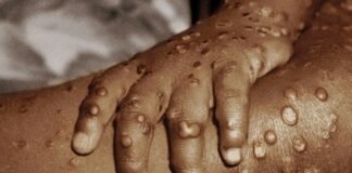 Emite México aviso epidemiológico por Viruela de Mono