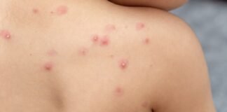 Nueva amenaza de salud se cierne sobre el mundo