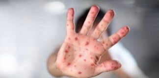 Viruela del Mono arribó a Canadá con 77 casos confirmados