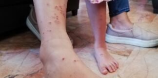 Registran más de 200 casos de varicela en menores de edad en Hidalgo