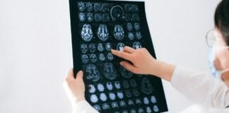 ¿Cómo detectar enfermedades cerebrovasculares?, segunda causa de muerte a nivel mundial