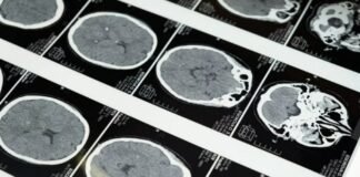 Tumores cerebrales: avances científicos dan a los pacientes mejor esperanza de vida