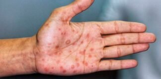 Nueva York declara emergencia de salud pública por viruela del mono