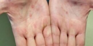 Registra Hidalgo más casos sospechosos de viruela de mono