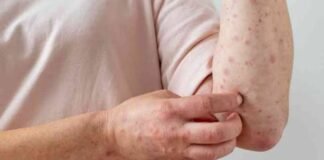 Confirman en Morelos cuarto caso de viruela símica