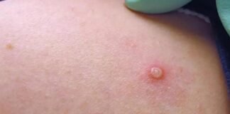 Confirman seis casos positivos de viruela símica en Hidalgo