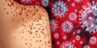 Detectan linaje latino de viruela símica B.1.6