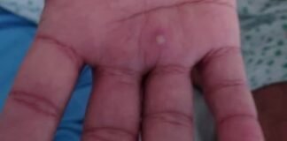 Hidalgo registra 21 casos de viruela de mono