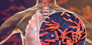 ¿Qué tan mortífera es la tuberculosis en México?