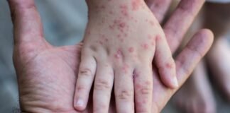 Viruela del mono no se ha ido; México suma 3 mil 928 contagios