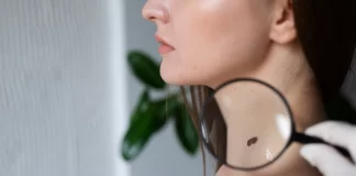 ¿Cuándo hay que preocuparse de lunares irregulares en la piel?