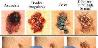 Alertan sobre riesgos a la salud por exposición prolongada a los rayos solares