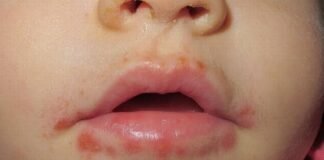 Cierran Centro Infantil por brote de coxsackie en Apan Hidalgo