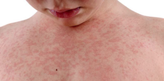 Aumentan casos de fiebre escarlata en Hidalgo: ¿Qué es y cómo prevenirla?