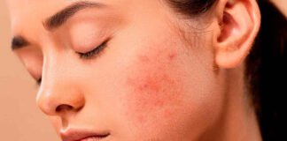 Impacto de la dermatitis atópica en niños y adultos: avances y tratamientos innovadores