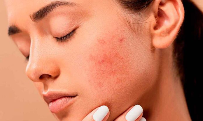 dermatitis atopica