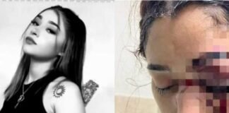 Dan de alta a Melani tras cirugía de ojo; faltan nariz y pómulo