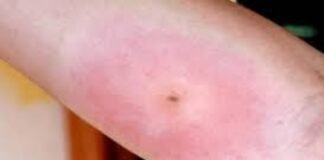 Usuaria del Metro sufrió una picadura de alacrán