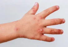 Pide Salud reforzar las medidas preventivas ante casos de Coxsackie