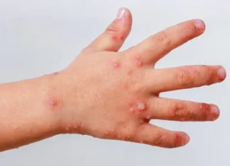 Pide Salud reforzar las medidas preventivas ante casos de Coxsackie