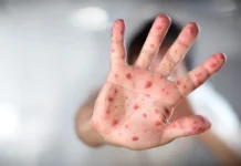 Chiapas emite alerta epidemiológica por sarampión