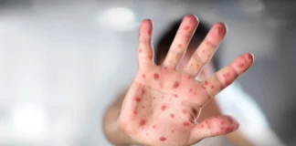 Chiapas emite alerta epidemiológica por sarampión