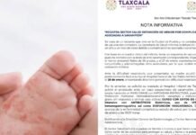 Muere bebé en Tlaxcala por complicaciones del sarampión