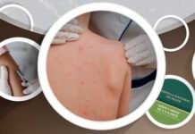 Reportan dos casos de sarampión en Hidalgo