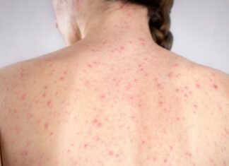 Confirma SSH décimo caso de sarampión en Hidalgo