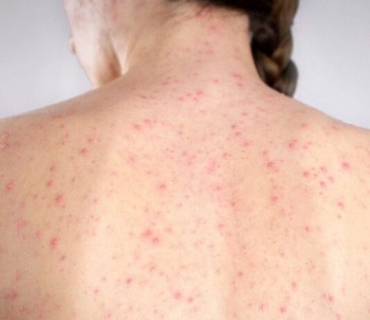 Confirma SSH décimo caso de sarampión en Hidalgo