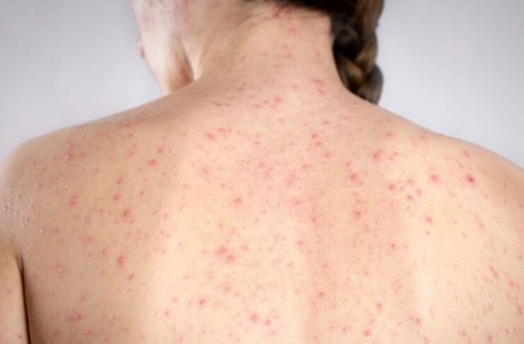 Confirma SSH décimo caso de sarampión en Hidalgo