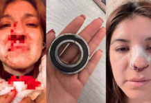 Pasajera sufre fractura de naríz durante riña de choferes de combi